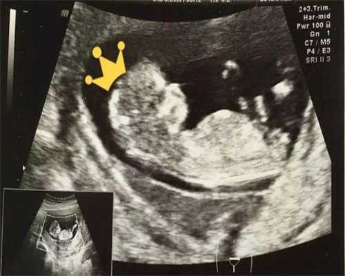 少精症做试管的条件是什么，少精症能试管婴儿吗