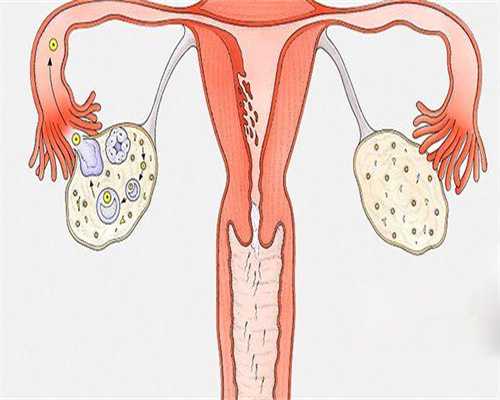 甲亢不孕可以做试管婴儿吗