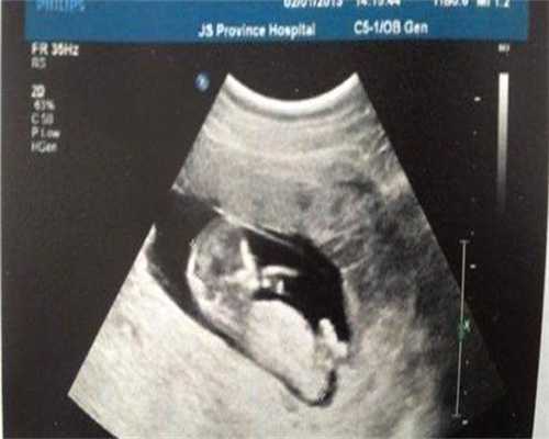 代怀机构费用:人工授精多胎怎么避免,人工授精多胎怎么避免胎停