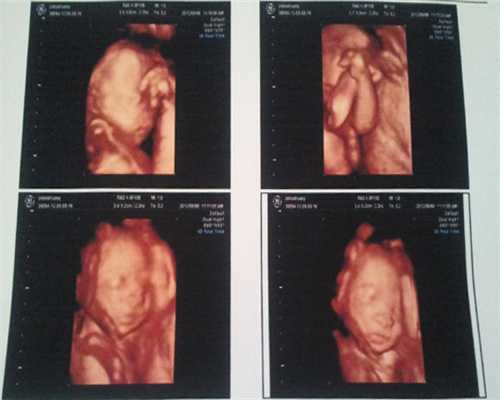 结扎再通做试管会宫外孕吗